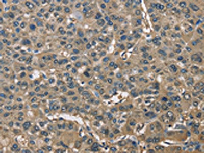 The image on the left is immunohistochemistry of paraffin-embedded Human liver cancer tissue using CSB-PA821534(ENO1 Antibody) at dilution 1/60, on the right is treated with fusion protein. (Original magnification: ×200)