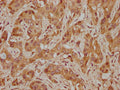 IHC image of CSB-PA821706LA01HU diluted at 1:300 and staining in paraffin-embedded human melanoma cancer performed on a Leica BondTM system. After dewaxing and hydration, antigen retrieval was mediated by high pressure in a citrate buffer (pH 6.0). Section was blocked with 10% normal goat serum 30min at RT. Then primary antibody (1% BSA) was incubated at 4°C overnight. The primary is detected by a biotinylated secondary antibody and visualized using an HRP conjugated SP system.