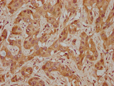 IHC image of CSB-PA821706LA01HU diluted at 1:300 and staining in paraffin-embedded human melanoma cancer performed on a Leica BondTM system. After dewaxing and hydration, antigen retrieval was mediated by high pressure in a citrate buffer (pH 6.0). Section was blocked with 10% normal goat serum 30min at RT. Then primary antibody (1% BSA) was incubated at 4°C overnight. The primary is detected by a biotinylated secondary antibody and visualized using an HRP conjugated SP system.