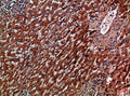 Immunohistochemical analysis of paraffin-embedded Human-liver-cancer, antibody was diluted at 1:100
