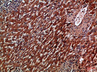 Immunohistochemical analysis of paraffin-embedded Human-liver-cancer, antibody was diluted at 1:100