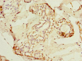 Immunohistochemistry of paraffin-embedded human breast cancer using CSB-PA822259ESR2HU at dilution of 1:100