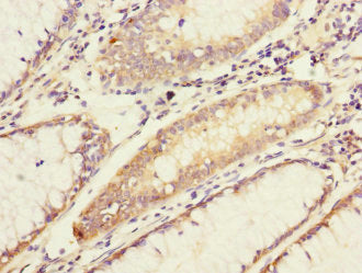 Immunohistochemistry of paraffin-embedded human colon cancer using CSB-PA822782ESR1HU at dilution of 1:100