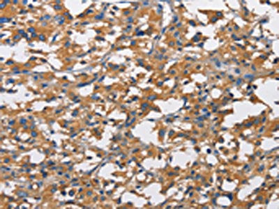 The image on the left is immunohistochemistry of paraffin-embedded Human thyroid cancer tissue using CSB-PA823804(NT5E Antibody) at dilution 1/50, on the right is treated with fusion protein. (Original magnification: ×200)