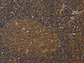 The image on the left is immunohistochemistry of paraffin-embedded Human tonsil tissue using CSB-PA823938(HSPA4 Antibody) at dilution 1/25, on the right is treated with fusion protein. (Original magnification: ×200)