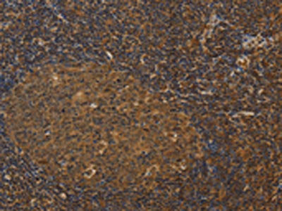 The image on the left is immunohistochemistry of paraffin-embedded Human tonsil tissue using CSB-PA823938(HSPA4 Antibody) at dilution 1/25, on the right is treated with fusion protein. (Original magnification: ×200)