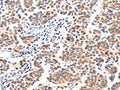 The image on the left is immunohistochemistry of paraffin-embedded Human breast cancer tissue using CSB-PA823966(GNRHR Antibody) at dilution 1/117, on the right is treated with synthetic peptide. (Original magnification: ×200)