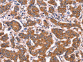 The image on the left is immunohistochemistry of paraffin-embedded Human breast cancer tissue using CSB-PA824118(COL20A1 Antibody) at dilution 1/40, on the right is treated with fusion protein. (Original magnification: ×200)