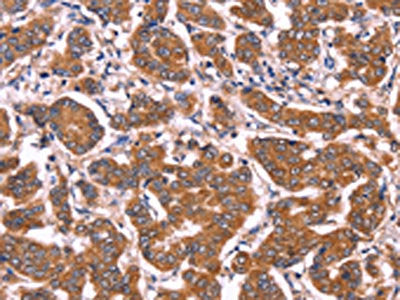 The image on the left is immunohistochemistry of paraffin-embedded Human breast cancer tissue using CSB-PA824118(COL20A1 Antibody) at dilution 1/40, on the right is treated with fusion protein. (Original magnification: ×200)