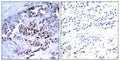 Immunohistochemical analysis of paraffin-embedded human breast carcinoma, using BCL-2 (phospho-Ser70) antibody.