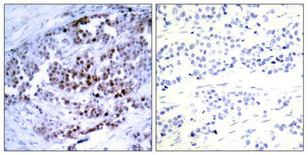 Immunohistochemical analysis of paraffin-embedded human breast carcinoma, using BCL-2 (phospho-Ser70) antibody.
