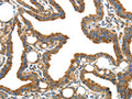 The image on the left is immunohistochemistry of paraffin-embedded Human thyroid cancer tissue using CSB-PA824414(IGFBP3 Antibody) at dilution 1/40, on the right is treated with synthetic peptide. (Original magnification: ×200)