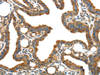 The image on the left is immunohistochemistry of paraffin-embedded Human thyroid cancer tissue using CSB-PA824414(IGFBP3 Antibody) at dilution 1/40, on the right is treated with synthetic peptide. (Original magnification: ×200)