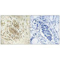 Immunohistochemistry analysis of paraffin-embedded human breast carcinoma tissue using POLE1 antibody.