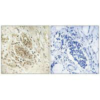 Immunohistochemistry analysis of paraffin-embedded human breast carcinoma tissue using POLE1 antibody.