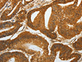 The image on the left is immunohistochemistry of paraffin-embedded Human colon cancer tissue using CSB-PA824653(RETNLB Antibody) at dilution 1/40, on the right is treated with fusion protein. (Original magnification: ×200)