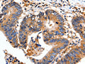 The image on the left is immunohistochemistry of paraffin-embedded Human colon cancer tissue using CSB-PA824751(FADD Antibody) at dilution 1/35, on the right is treated with fusion protein. (Original magnification: ×200)