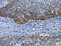 The image on the left is immunohistochemistry of paraffin-embedded Human cervical cancer tissue using CSB-PA824881(HOMER1 Antibody) at dilution 1/50, on the right is treated with fusion protein. (Original magnification: ×200)