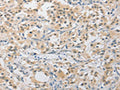The image on the left is immunohistochemistry of paraffin-embedded Human thyroid cancer tissue using CSB-PA825036(APLF Antibody) at dilution 1/40, on the right is treated with fusion protein. (Original magnification: ×200)