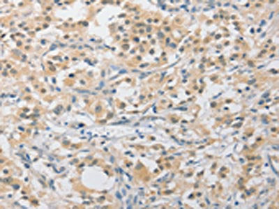 The image on the left is immunohistochemistry of paraffin-embedded Human thyroid cancer tissue using CSB-PA825036(APLF Antibody) at dilution 1/40, on the right is treated with fusion protein. (Original magnification: ×200)