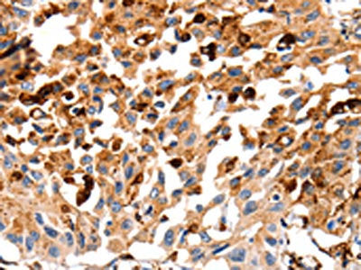 The image on the left is immunohistochemistry of paraffin-embedded Human lung cancer tissue using CSB-PA825136(CTSB Antibody) at dilution 1/35, on the right is treated with fusion protein. (Original magnification: ×200)