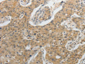The image on the left is immunohistochemistry of paraffin-embedded Human lung cancer tissue using CSB-PA825267(IL1B Antibody) at dilution 1/20, on the right is treated with fusion protein. (Original magnification: ×200)