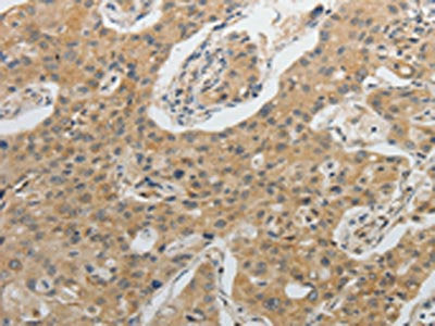 The image on the left is immunohistochemistry of paraffin-embedded Human lung cancer tissue using CSB-PA825267(IL1B Antibody) at dilution 1/20, on the right is treated with fusion protein. (Original magnification: ×200)