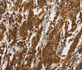 Immunohistochemical analysis of paraffin-embedded Human gastric cancer tissue using at dilution 1/25.