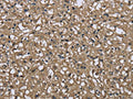 The image on the left is immunohistochemistry of paraffin-embedded Human prostate cancer tissue using CSB-PA825632(FBP1 Antibody) at dilution 1/40, on the right is treated with fusion protein. (Original magnification: ×200)
