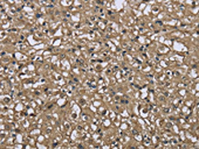 The image on the left is immunohistochemistry of paraffin-embedded Human prostate cancer tissue using CSB-PA825632(FBP1 Antibody) at dilution 1/40, on the right is treated with fusion protein. (Original magnification: ×200)