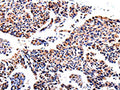 The image on the left is immunohistochemistry of paraffin-embedded Human lung cancer tissue using CSB-PA825868(AKR1B1 Antibody) at dilution 1/40, on the right is treated with fusion protein. (Original magnification: ×200)