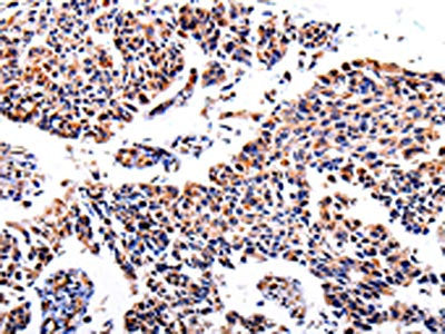 The image on the left is immunohistochemistry of paraffin-embedded Human lung cancer tissue using CSB-PA825868(AKR1B1 Antibody) at dilution 1/40, on the right is treated with fusion protein. (Original magnification: ×200)