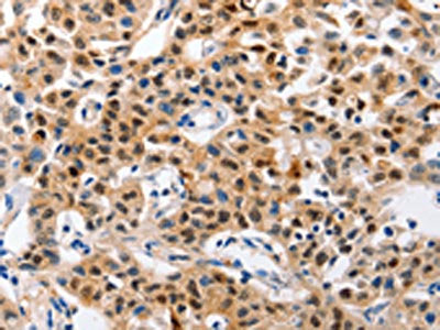 The image on the left is immunohistochemistry of paraffin-embedded Human lung cancer tissue using CSB-PA826461(GCG(GLP1) Antibody) at dilution 1/30, on the right is treated with synthetic peptide. (Original magnification: ×200)