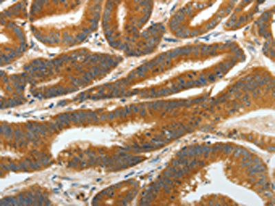 The image on the left is immunohistochemistry of paraffin-embedded Human colon cancer tissue using CSB-PA826561(RGS2 Antibody) at dilution 1/40, on the right is treated with fusion protein. (Original magnification: ×200)