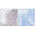 Immunohistochemistry analysis of paraffin-embedded human cervix carcinoma tissue using POLG2 antibody.