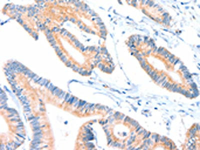 The image on the left is immunohistochemistry of paraffin-embedded Human colon cancer tissue using CSB-PA826742(ACOX2 Antibody) at dilution 1/25, on the right is treated with fusion protein. (Original magnification: ×200)