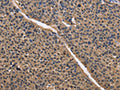 The image on the left is immunohistochemistry of paraffin-embedded Human liver cancer tissue using CSB-PA826954(IDH1 Antibody) at dilution 1/50, on the right is treated with fusion protein. (Original magnification: ×200)
