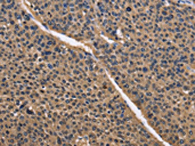 The image on the left is immunohistochemistry of paraffin-embedded Human liver cancer tissue using CSB-PA826954(IDH1 Antibody) at dilution 1/50, on the right is treated with fusion protein. (Original magnification: ×200)
