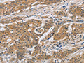 The image on the left is immunohistochemistry of paraffin-embedded Human ovarian cancer tissue using CSB-PA827150(CST6 Antibody) at dilution 1/30, on the right is treated with fusion protein. (Original magnification: ×200)