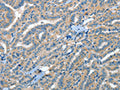 The image on the left is immunohistochemistry of paraffin-embedded Human thyroid cancer tissue using CSB-PA827156(RAP1A Antibody) at dilution 1/35, on the right is treated with fusion protein. (Original magnification: ×200)