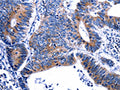 The image on the left is immunohistochemistry of paraffin-embedded Human colon cancer tissue using CSB-PA827246(GIP Antibody) at dilution 1/13, on the right is treated with fusion protein. (Original magnification: ×200)