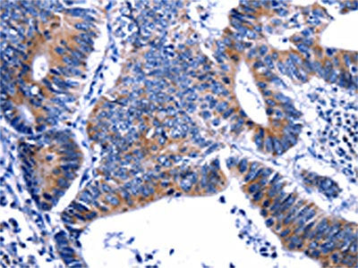 The image on the left is immunohistochemistry of paraffin-embedded Human colon cancer tissue using CSB-PA827246(GIP Antibody) at dilution 1/13, on the right is treated with fusion protein. (Original magnification: ×200)
