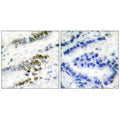 Immunohistochemical analysis of paraffin-embedded human lung carcinoma tissue using ERCC1 antibody.