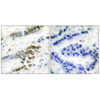 Immunohistochemical analysis of paraffin-embedded human lung carcinoma tissue using ERCC1 antibody.