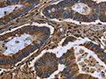 The image on the left is immunohistochemistry of paraffin-embedded Human colon cancer tissue using CSB-PA827609(FGB Antibody) at dilution 1/20, on the right is treated with fusion protein. (Original magnification: ×200)