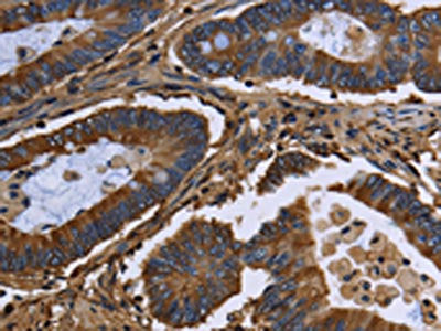 The image on the left is immunohistochemistry of paraffin-embedded Human colon cancer tissue using CSB-PA827609(FGB Antibody) at dilution 1/20, on the right is treated with fusion protein. (Original magnification: ×200)
