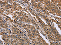 The image on the left is immunohistochemistry of paraffin-embedded Human liver cancer tissue using CSB-PA828051(FAM3B Antibody) at dilution 1/40, on the right is treated with fusion protein. (Original magnification: ×200)