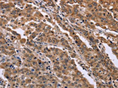 The image on the left is immunohistochemistry of paraffin-embedded Human liver cancer tissue using CSB-PA828051(FAM3B Antibody) at dilution 1/40, on the right is treated with fusion protein. (Original magnification: ×200)