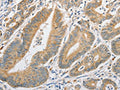 The image on the left is immunohistochemistry of paraffin-embedded Human colon cancer tissue using CSB-PA828297(ATG10 Antibody) at dilution 1/60, on the right is treated with fusion protein. (Original magnification: ×200)