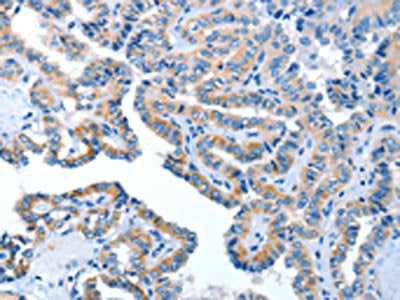 The image on the left is immunohistochemistry of paraffin-embedded Human thyroid cancer tissue using CSB-PA828335(AMDHD2 Antibody) at dilution 1/40, on the right is treated with fusion protein. (Original magnification: ×200)